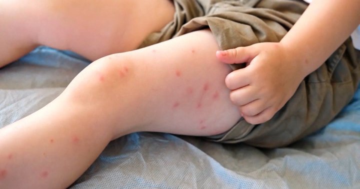 Soaring number of Alberta measles cases worries health officials in both Canada, U.S.